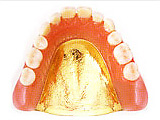 ゴールド床入れ歯