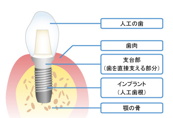 インプラント